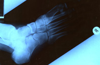 x-ray of my right foot